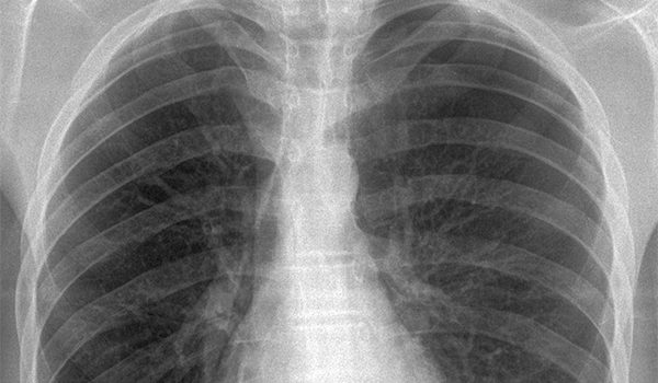 63-year-old female complaining of pain in throat