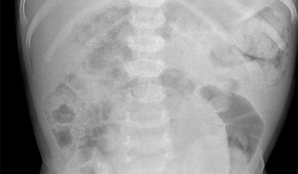 2-1/2 year-old with recurrent abdominal pain