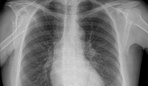 57-year old patient bothered by a troublesome cough