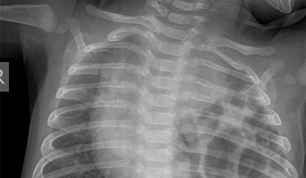 33-year-old patient presenting vomiting and chest pain