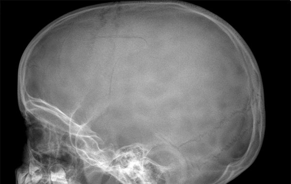 4-year-old patient incurs blow to head