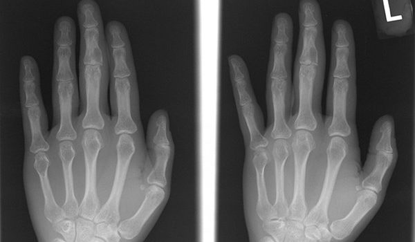Woman with minor finger trauma
