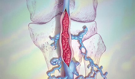 Management of Venous Thromboembolism in Urgent Care