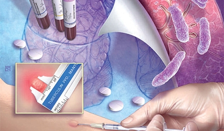 Tuberculosis Screening in Urgent Care Medicine