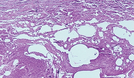 Promethazine-induced Tissue Necrosis: A Case Presentation