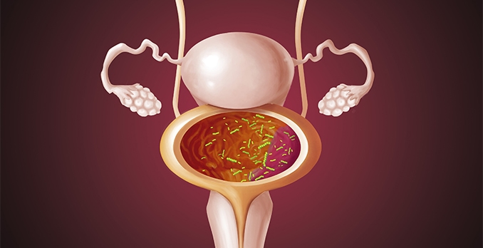 Antibiotic Management of Acute Uncomplicated Cystitis and Pyelonephritis in Women