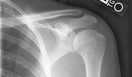 A 23-year-old Woman with a Scapular Fracture