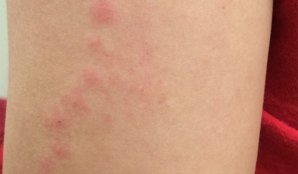 Woman with rash