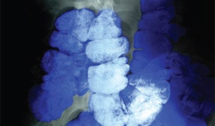 Management of Patients Presenting with Constipation