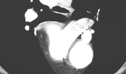 A Patient with Suspected Pulmonary Embolism