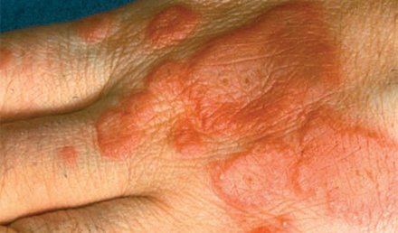 Management of Erythema Multiforme in the Urgent Care Setting
