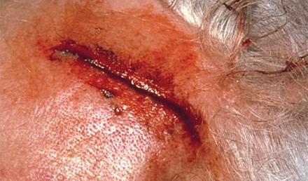 Common Lacerations of the Head