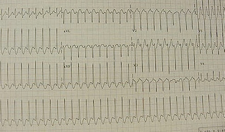 Supraventricular Tachycardia in a Child with Williams Syndrome after Nebulized Albuterol