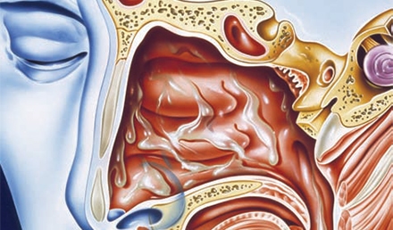 Management of the Patient Presenting with Epistaxis