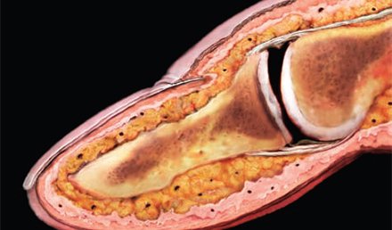 Assessment and Initial Care of Fingertip and Nailbed Injuries