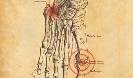 Managing Foot Fractures in Urgent Care