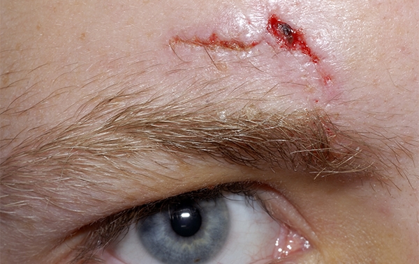 Repair of Lacerations the Face and Scalp: 1 - Journal of Urgent Care Medicine