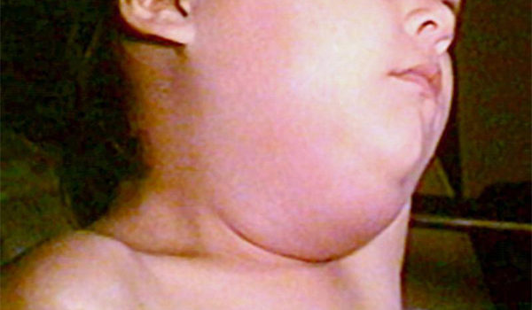 Child with Lymphedema of the Neck and Parotid Glands