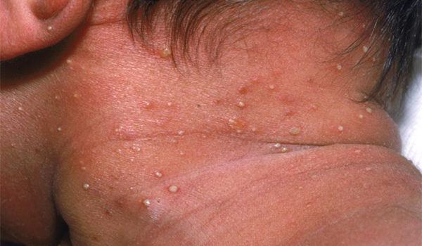 Baby Born with Pustules on the Neck
