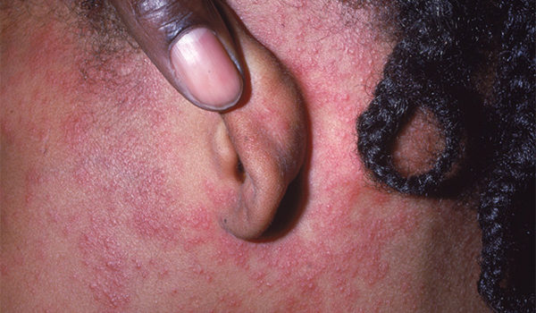 Is It Measles or Something Else? Is It Measles or Something Else?