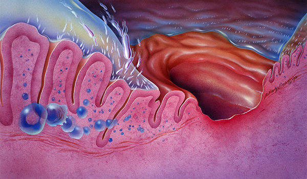 Upper Gastrointestinal Disorders in Urgent Care, Part 1: Gastritis, Peptic Ulcer Disease, and Helicobacter pylori