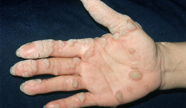 Woman with Papules on the Hand