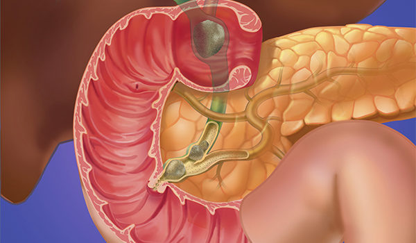 Upper Gastrointestinal Disorders in Urgent Care, Part 2: Biliary Tract and Pancreatic Disease