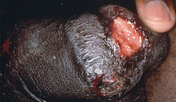 Man with Painful Genital Ulcers