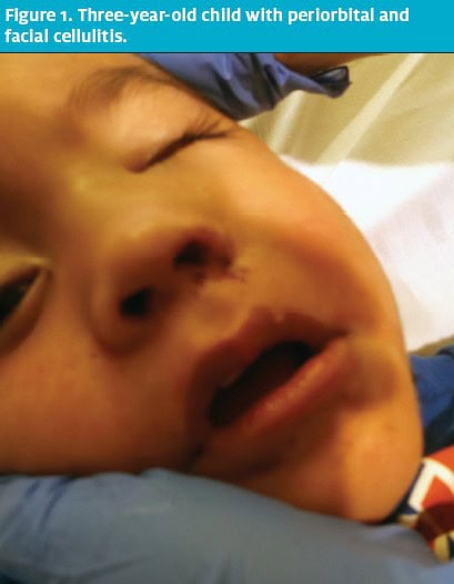 Pediatric Periorbital Cellulitis