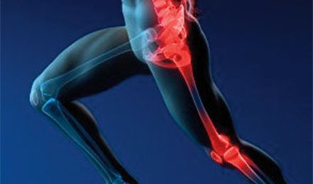 Acute Severe Thigh Pain While Running