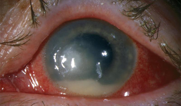 Eye Redness, Pain, and Light Sensitivity