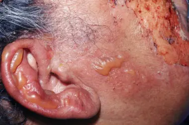 Rash, Facial Palsy, and Ear Pain