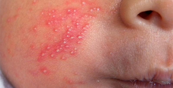 Skin Rash with Pustules on a Newborn