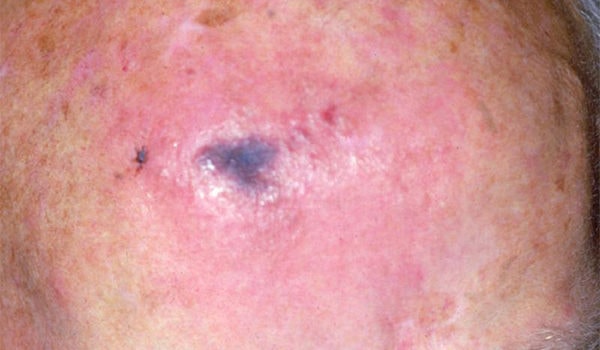 Adult with Painful Lesion That Enlarges and Darkens