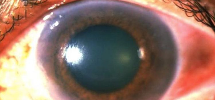 Blurred Vision and Painful Red Eye in a 40-Year-Old Patient