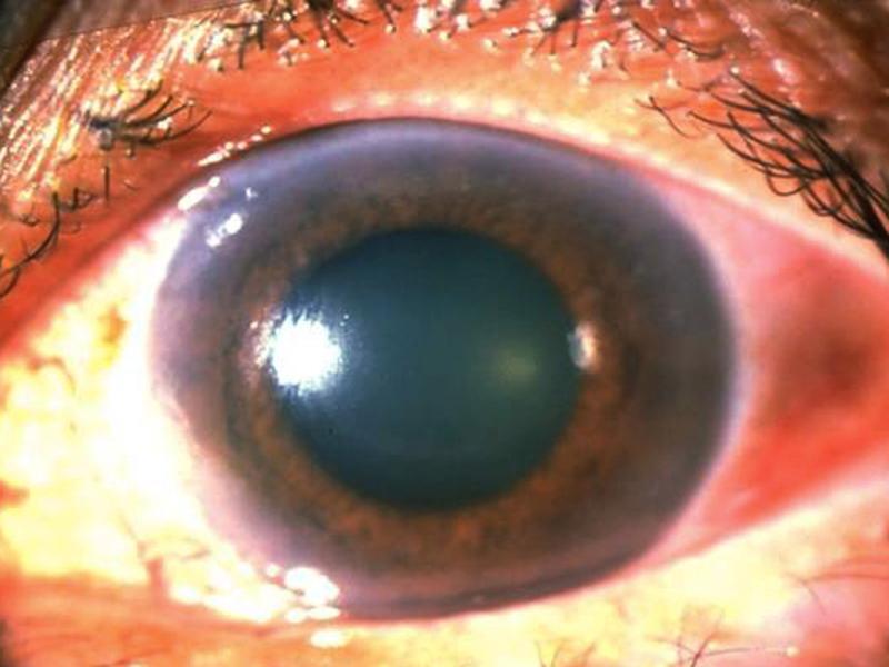 red eye sensitive to light blurred vision