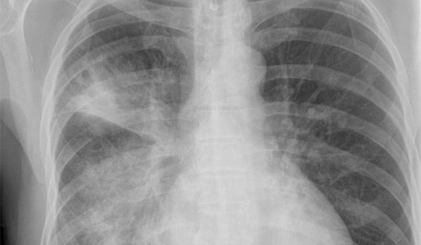 Eighteen-Year-Old with Cough and Yellow Sputum