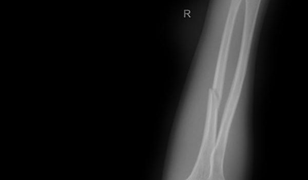 Forearm Pain in a 12-Year-Old Patient After a Fall