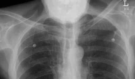 Chronic Cough and Shortness of Breath