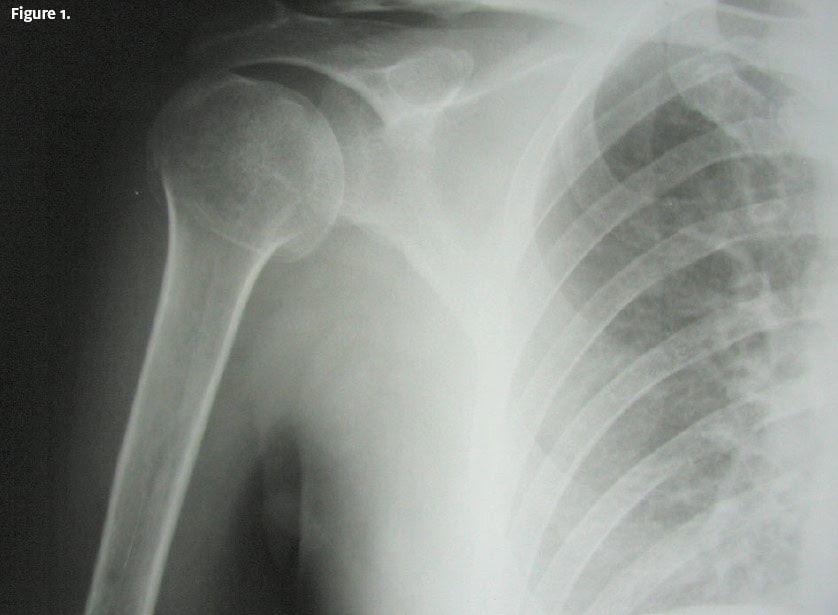 proximal humerus fracture
