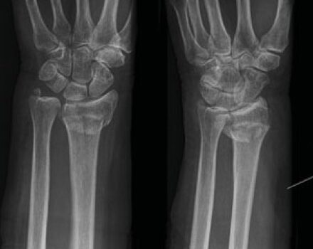 Wrist Pain in an Adult After a Fall