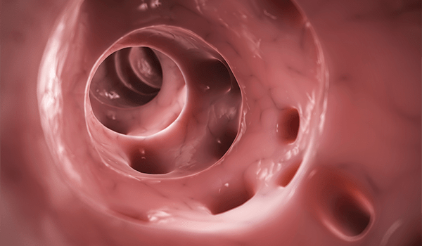 Diverticulitis in the Urgent Care Setting