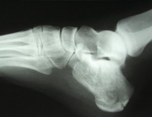 Heel and Ankle Pain in an Adult After a Jump from a Second-Floor Window