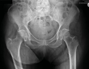 Hip Pain in an Adult After a Fall
