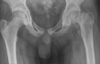 Knee Pain in an 8-Year-Old Boy