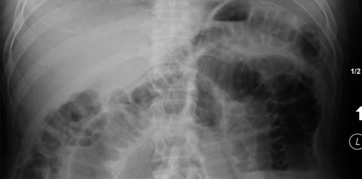 Constipation in a 67-Year-Old Man