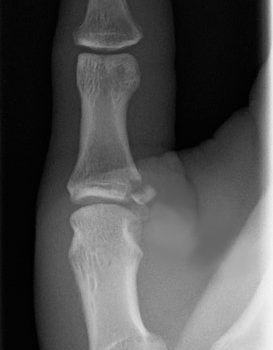 Painful Metacarpophalangeal Joint After a Skiing Fall