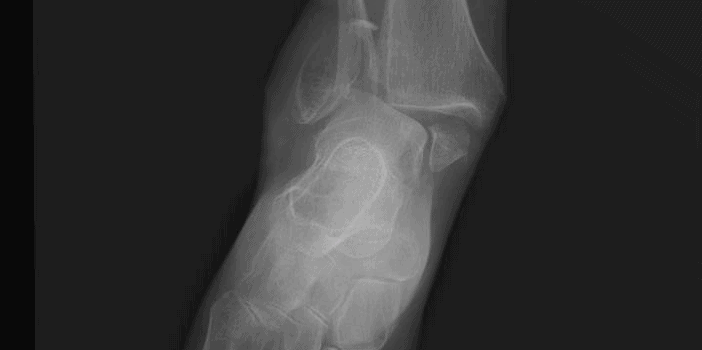 Ankle Injury Sustained During a Step Off a Curb