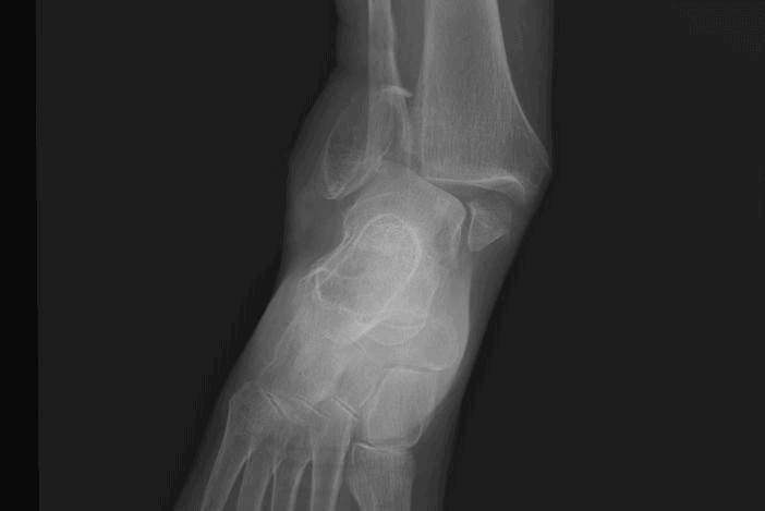 imgchllg_bimalleolarfracture_figure