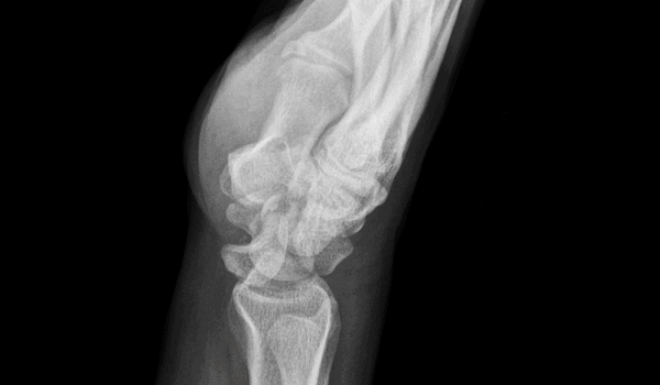 Wrist Pain After Tripping and Falling